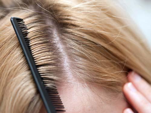 صور - كيفية علاج قشرة الشعر نهائيا بطريقة طبيعية