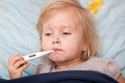 صور - ما هي اعراض وعلامات مرض الحصبة عند الاطفال ؟